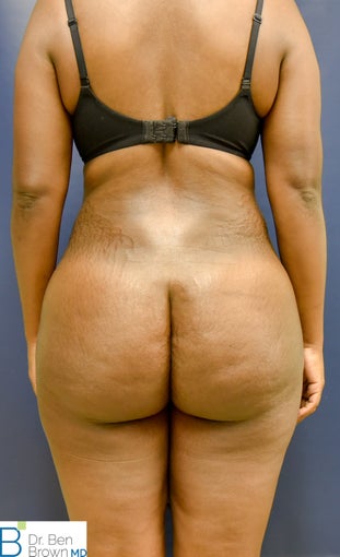 35-44 year old woman treated with Brazilian Butt Lift after 3389849