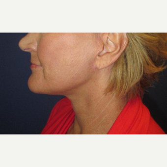 55-64 year old woman treated with Facelift after 3333546