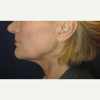 55-64 year old woman treated with Facelift before 3333546