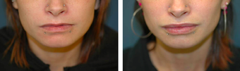 Lip Augmentation with Implant before 1098212