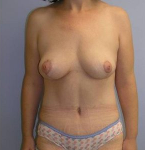 Mommy Makeover after 256360