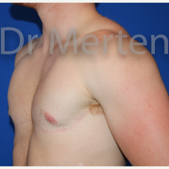 18-24 year old man treated with FTM Chest Masculinization Surgery after 3829057