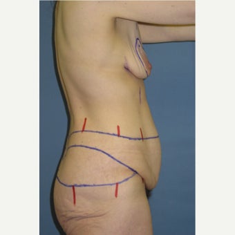 35-44 year old woman treated with Body Lift 1835103