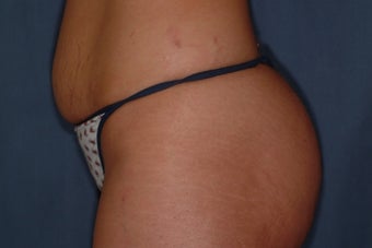 25 Year Old Female with Mini-Tummy Tuck before 1180751