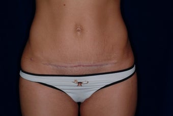 25 Year Old Female with Mini-Tummy Tuck 1180751