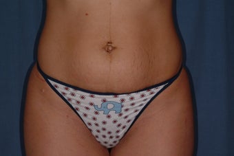 25 Year Old Female with Mini-Tummy Tuck 1180751