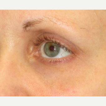 25-34 year old woman treated with Restylane before 3331158