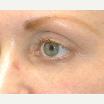 25-34 year old woman treated with Restylane after 3331158
