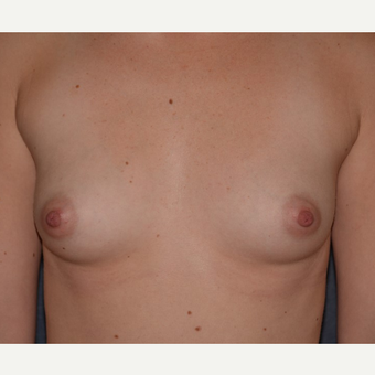 25-34 year old woman treated with Breast Augmentation before 3455329