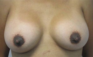 Breast Augmentation after 3054801