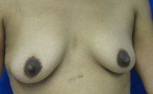 Breast Augmentation before 3054801