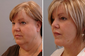 Mid Face Cheek Lift before 1360159