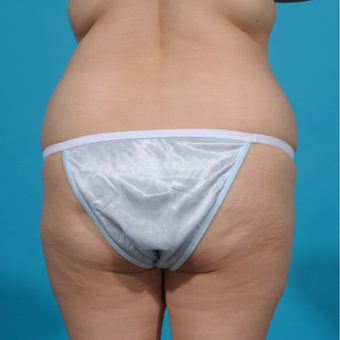 25-34 year old woman treated with Brazilian Butt Lift before 3292855