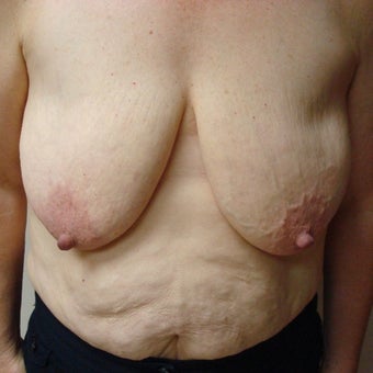 45-54 year old woman treated with Mentor Breast Implants before 2596219