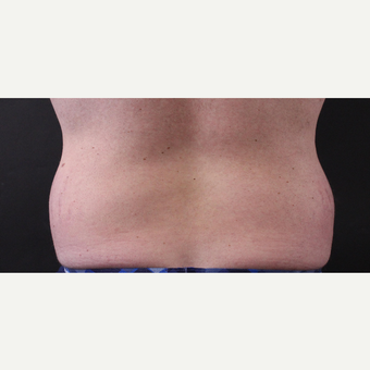 30 year old man treated with CoolSculpting before 3630351