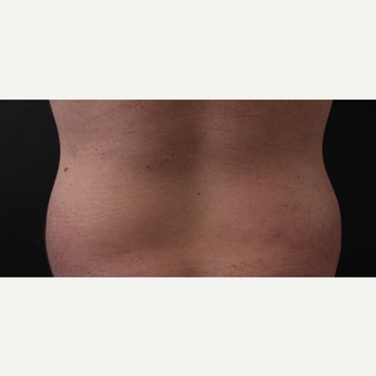 30 year old man treated with CoolSculpting after 3630351