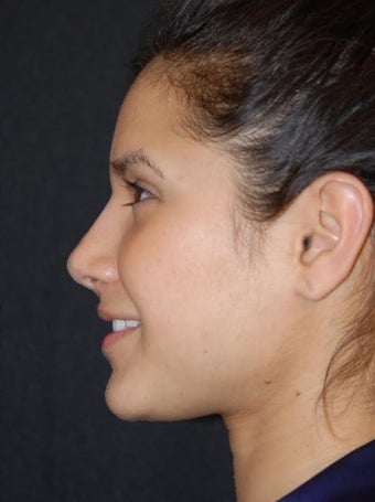 25-34 year old woman treated with Non Surgical Nose Job after 2728395