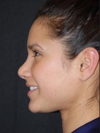 25-34 year old woman treated with Non Surgical Nose Job before 2728395