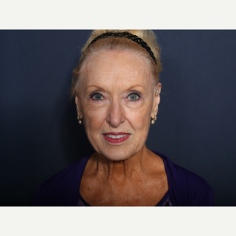 75 and up year old woman treated with Facelift (view 1 of 2) before 3710589