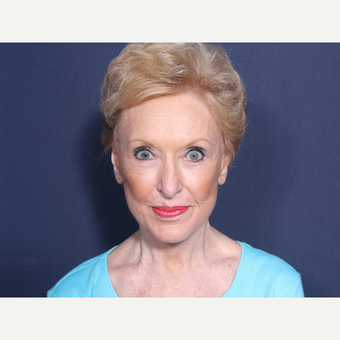 75 and up year old woman treated with Facelift (view 1 of 2) after 3710589