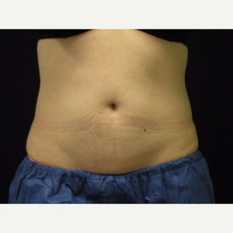 25-34 year old woman treated with CoolSculpting after 3679804
