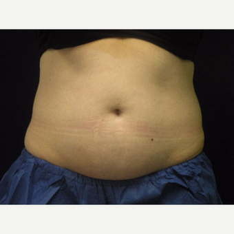 25-34 year old woman treated with CoolSculpting before 3679804