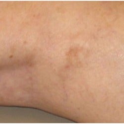 45-54 year old woman treated for spider veins with sclerotherapy after 1655543