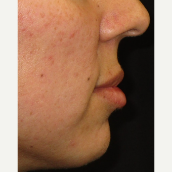 25-34 year old woman treated with Juvederm after 3153642