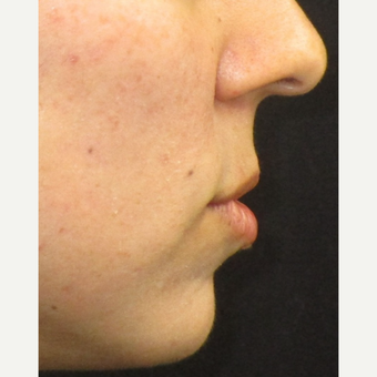 25-34 year old woman treated with Juvederm before 3153642