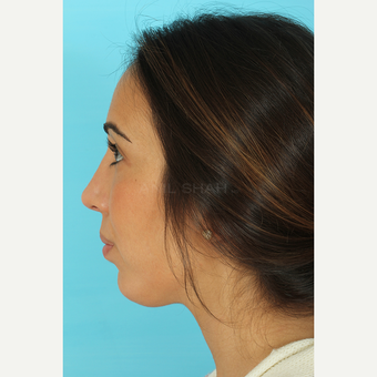 25-34 year old woman treated with Rhinoplasty after 3691142