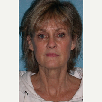62 year old female with facelift before 3732618