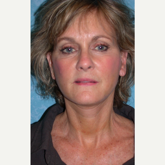 62 year old female with facelift after 3732618