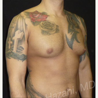 35-44 year old man treated with Male Breast Reduction before 3351886