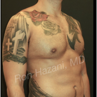 35-44 year old man treated with Male Breast Reduction after 3351886
