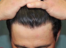 42-Year-Old Man With A Receding Front Hairline after 1293920