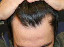 42-Year-Old Man With A Receding Front Hairline before 1293920