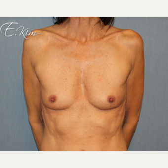 25-34 year old woman treated with Breast Augmentation before 3663264