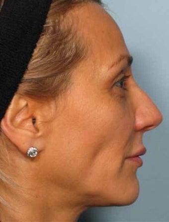 Botox combined with Radiesse before 349880