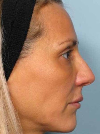 Botox combined with Radiesse after 349880