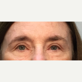 55-64 year old woman treated with Eyelid Surgery after 3399722