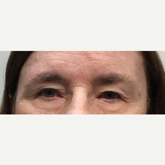 55-64 year old woman treated with Eyelid Surgery before 3399722