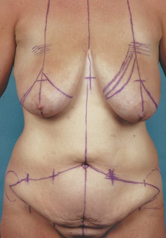 Drainless Abdominoplasty (Tummy Tuck) before 1474836