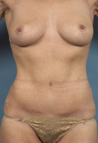 Drainless Abdominoplasty (Tummy Tuck) after 1474836