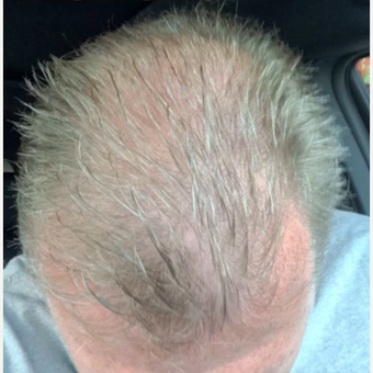 45-54 year old man treated with NeoGraft after 3325582