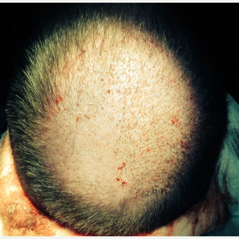 45-54 year old man treated with NeoGraft before 3325582