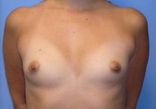 Breast Augmentation before 256387