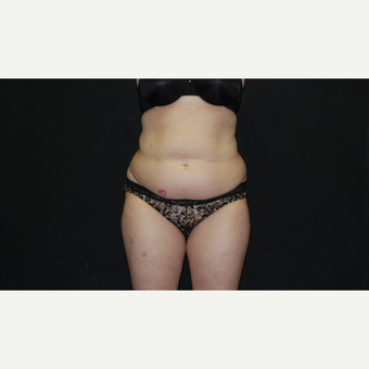 35-44 year old woman treated with Tummy Tuck before 3027406