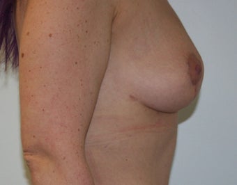 25-34 year old woman treated with Fat Transfer 1676917