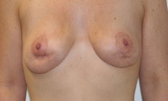 25-34 year old woman treated with Fat Transfer before 1676917