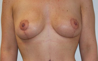 25-34 year old woman treated with Fat Transfer after 1676917
